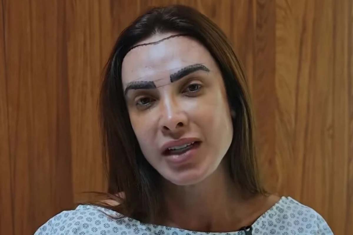 Nicole Bahls realiza transplante capilar após alopecia e comemora