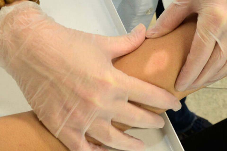 Prefeitura de Jaru realizará ação para o diagnóstico precoce da Hanseníase