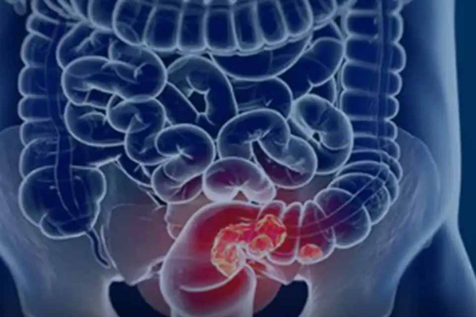 Estudo projeta aumento de 36% em mortes por câncer colorretal até 2040