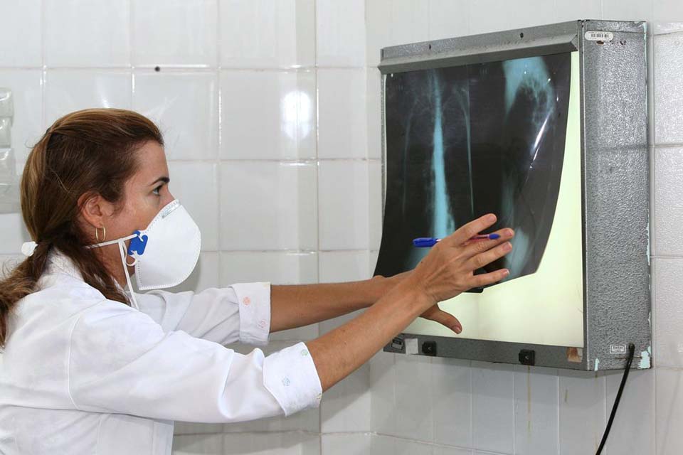 Ministério da Saúde registra quase 80 mil novos casos de tuberculose no país 