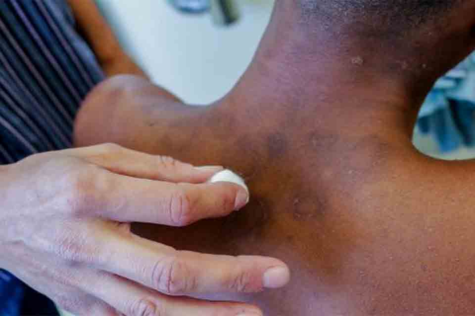 Inteligência artificial pode acelerar diagnóstico de hanseníase