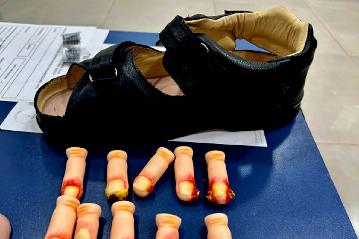 Atenção nas UBS previne complicações do pé diabético e garante acesso a calçados terapêuticos