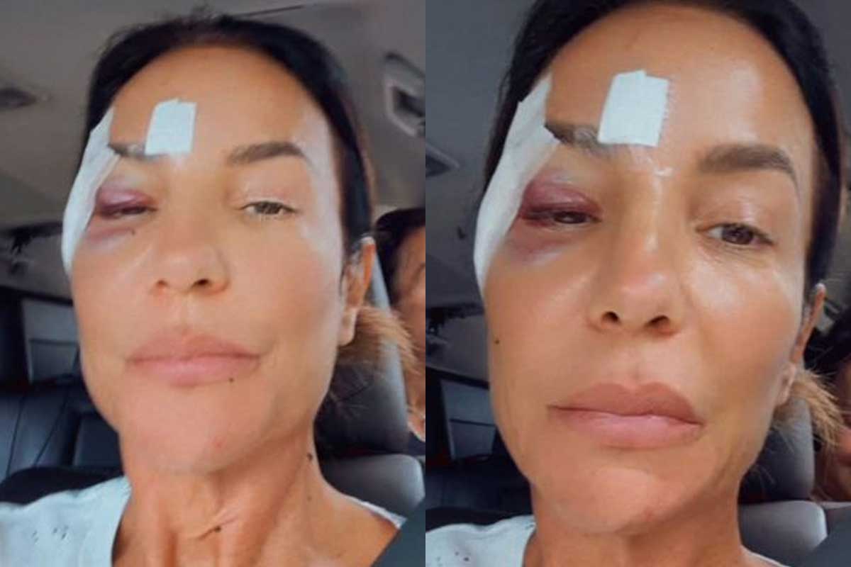 Ivete Sangalo reaparece após internação e brinca com hematomas: “Estou maravilhosa!”