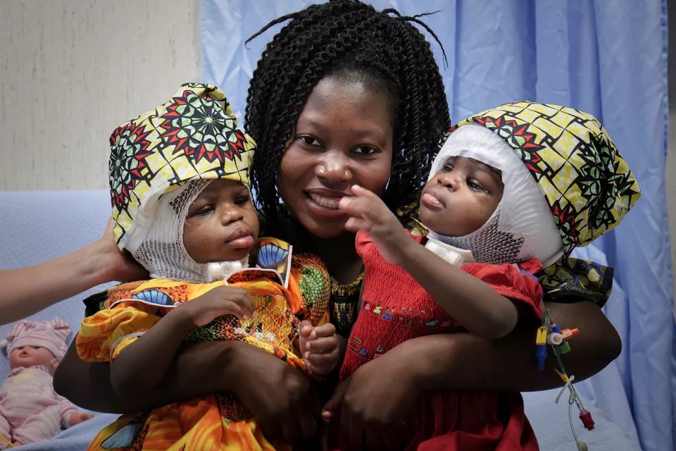 Gêmeas siamesas são separadas pela cabeça na Itália