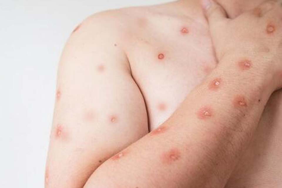 Região Norte do Brasil registra casos de mpox