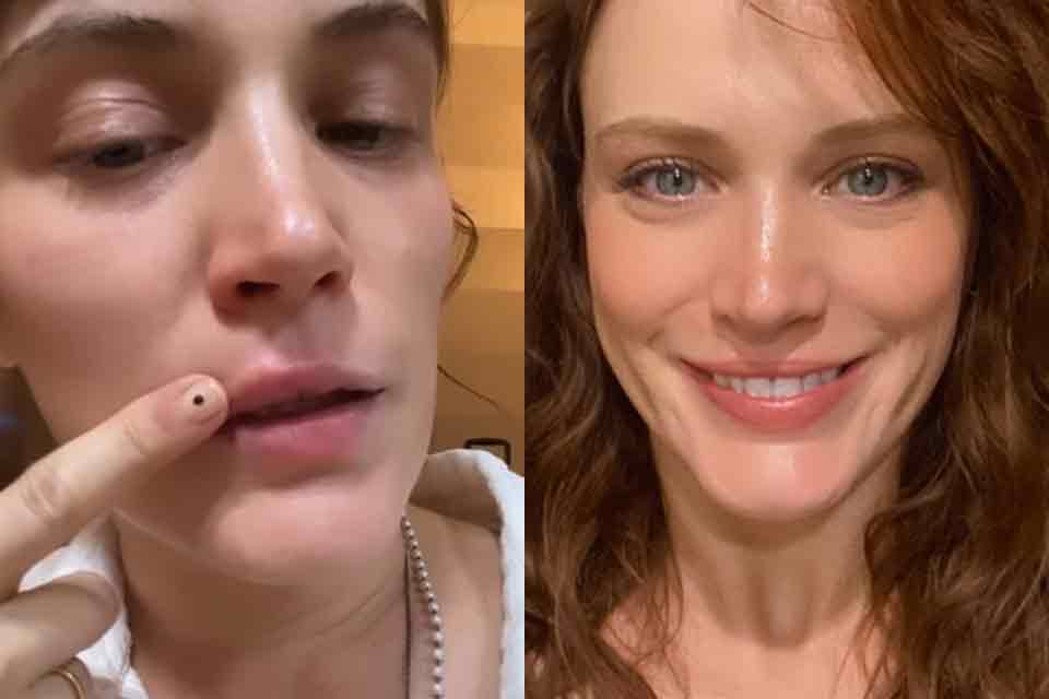 Bianca Bin sofre reação alérgica após picada: “Parece herpes, né?”