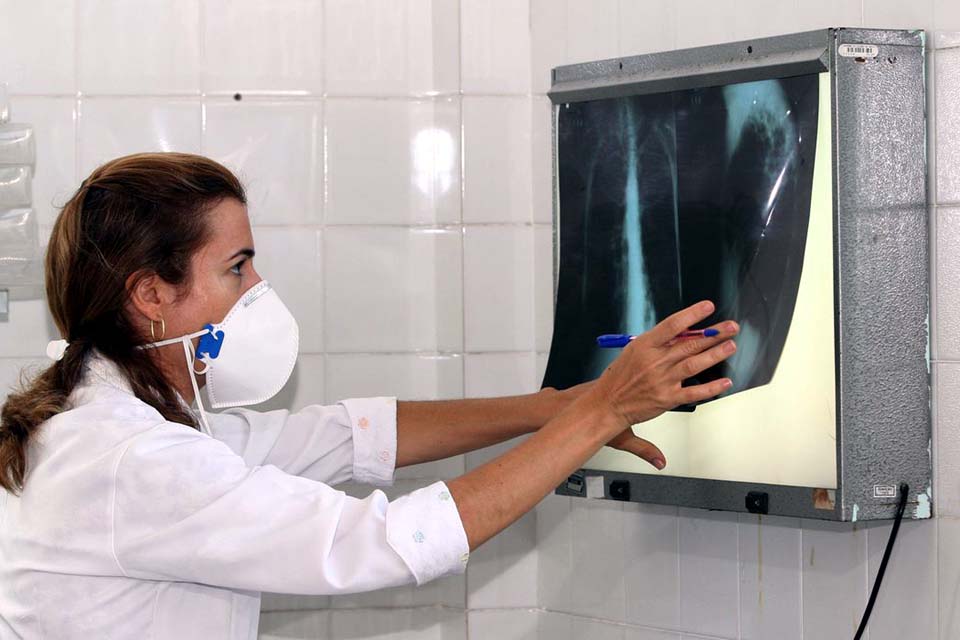 Governo cria comitê para reduzir casos de tuberculose até 2030