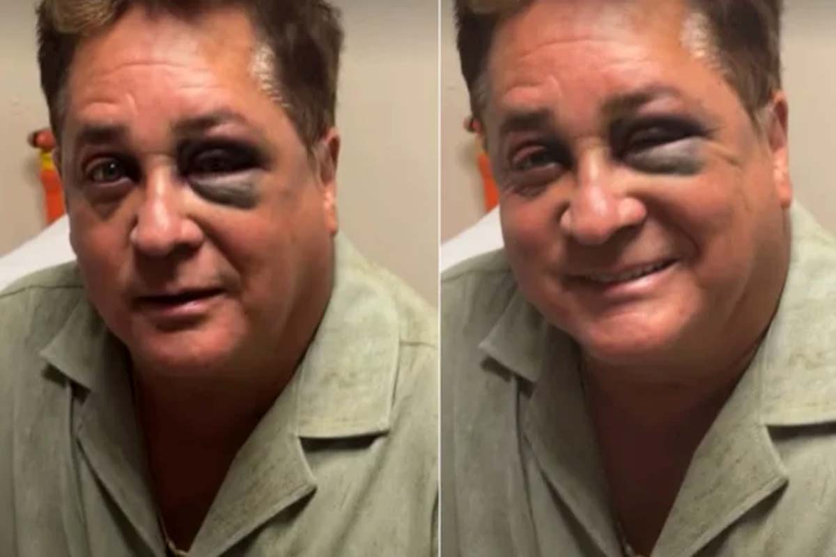 Leonardo sofre acidente durante pescaria e mostra olho roxo: 