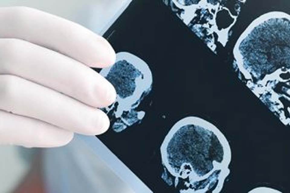 Risco de problemas neurológicos após Covid continua por até 2 anos, diz estudo