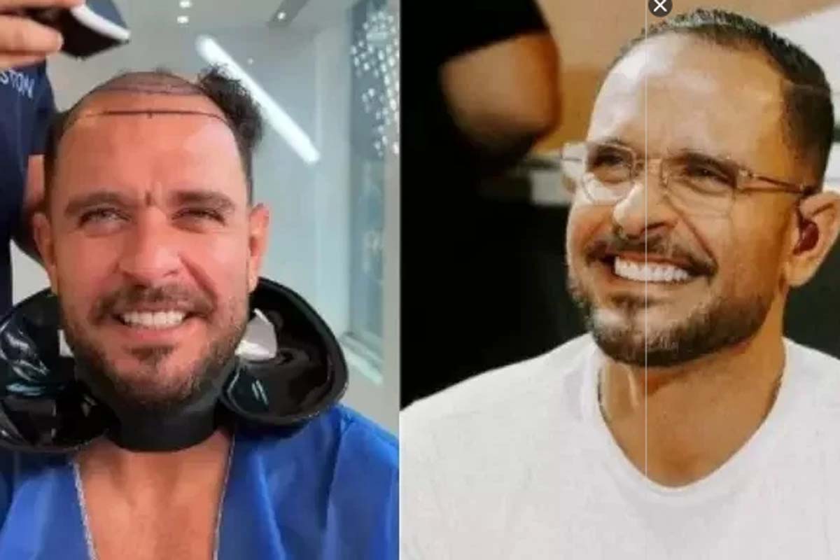 Diogo Nogueira raspa o cabelo e levanta suspeitas sobre possível transplante capilar