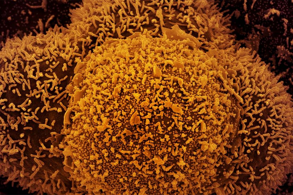 Nova subvariante da covid-19 é identificada em Mato Grosso