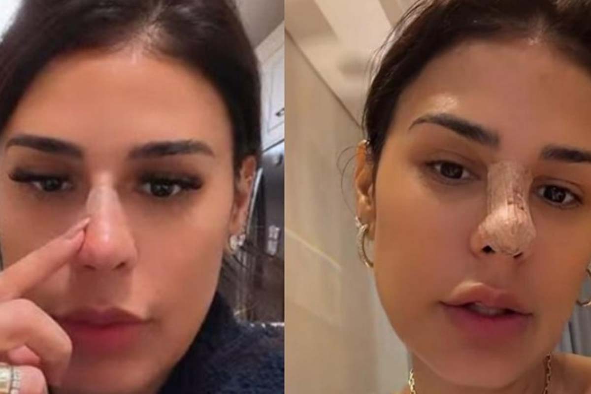 Simone Mendes nega cirurgia ao aparecer com nariz diferente