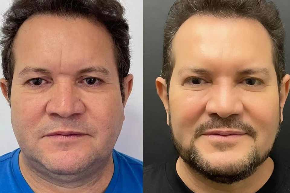 Ximbinha faz rejuvenescimento facial e recebe elogios dos fãs: “Meu Deus!! Para tudo, muito gato”