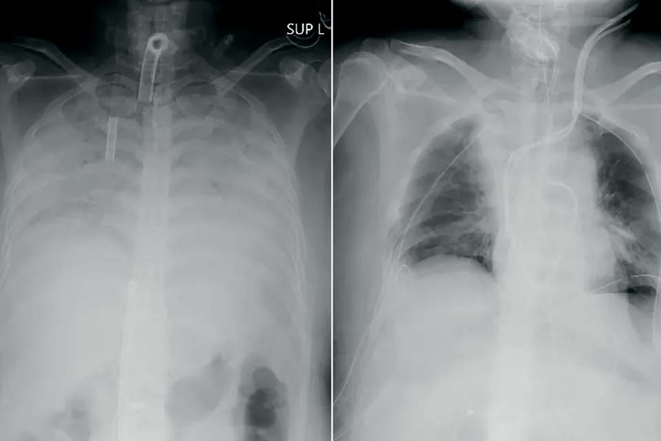 Paciente com Covid recebe transplante de pulmão de doadores vivos no Japão