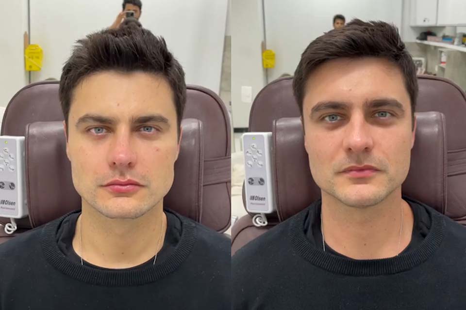 Guilherme Leicam faz harmonização facial e botox no rosto todo