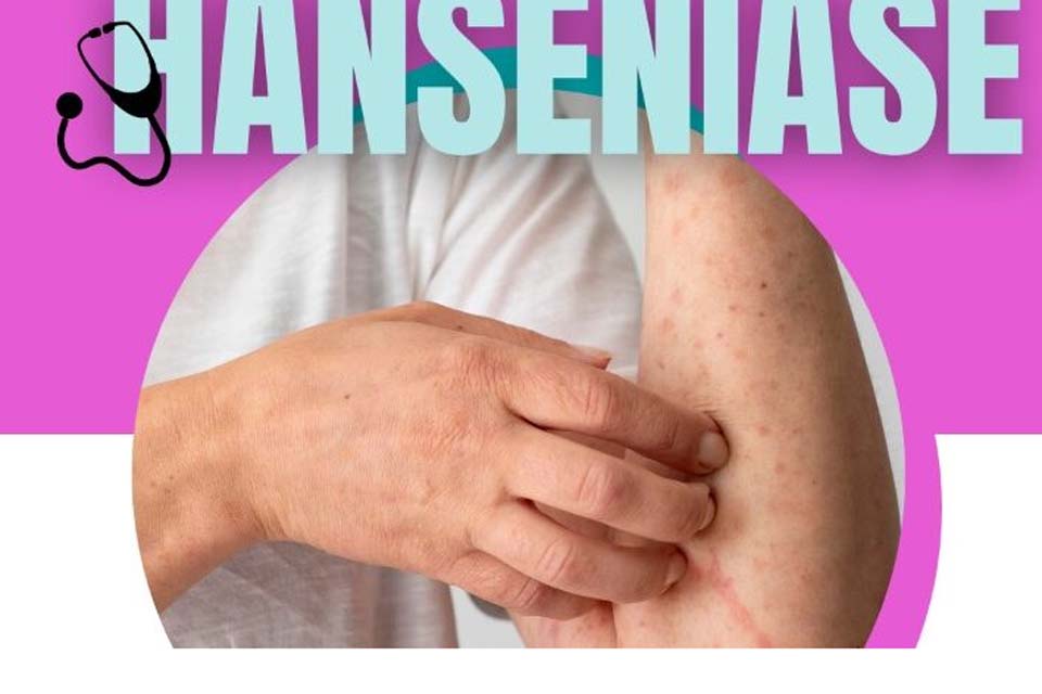 Secretaria de Saúde alerta sobre o diagnóstico e o tratamento precoce da hanseníase