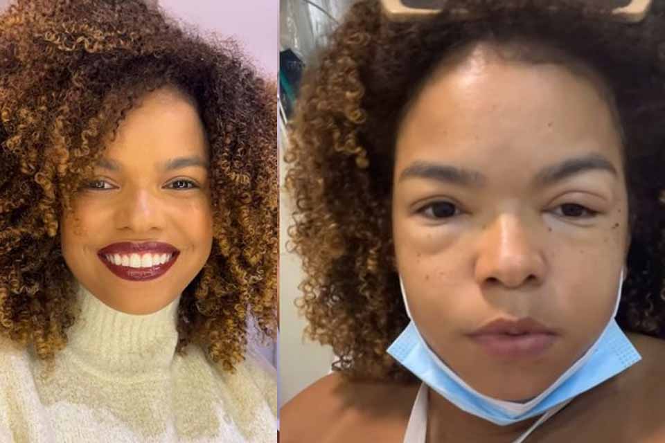 Jeniffer Nascimento mostra reação alérgica causada por lagosta e foto impressiona