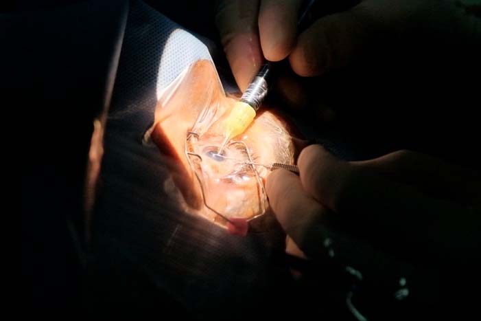 Mais de 400 cirurgias de catarata são realizadas em cinco dias no município