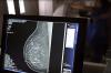 Plano de saúde terá que cobrir mamografia digital para todas as idades