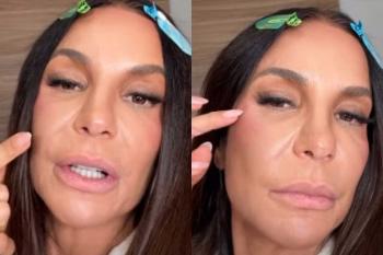 “Estou bonita!”: Ivete Sangalo mostra recuperação após cirurgia no rosto