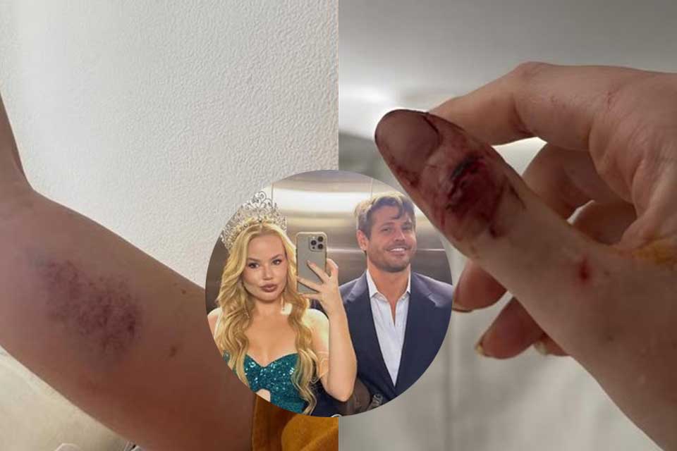 Ex divulga imagens e relata agressões cometidas por Dado Dolabella