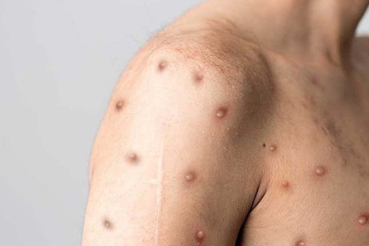 Prefeitura de Jaru orienta população em casos de suspeita de Mpox