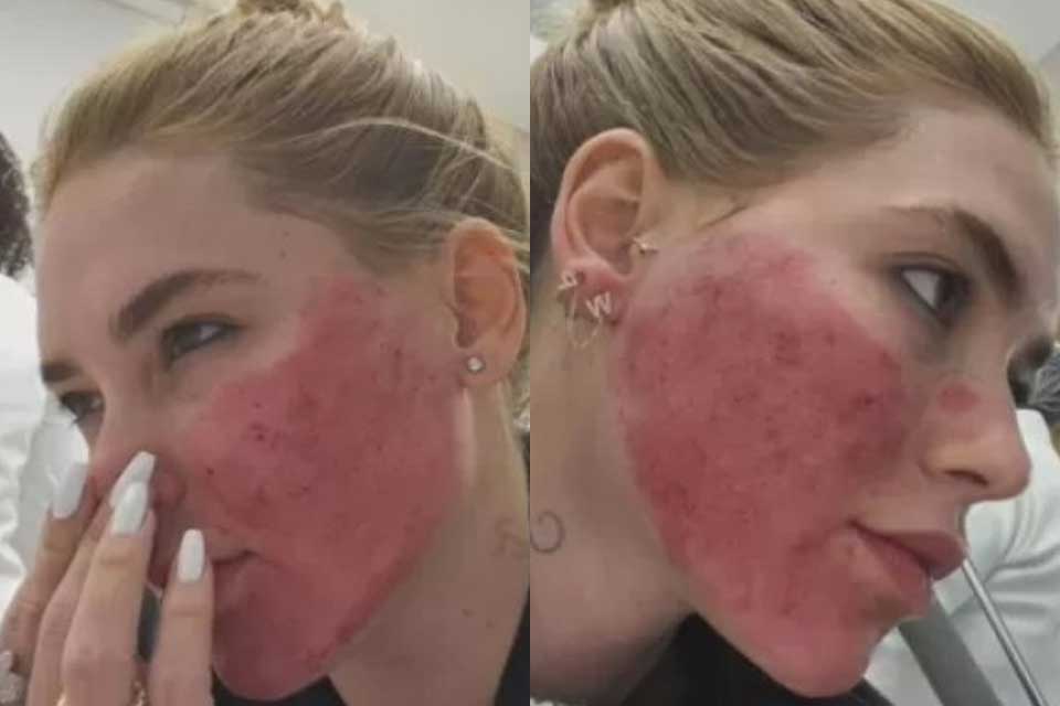 Virginia assusta seguidores ao exibir rosto após procedimentos estéticos