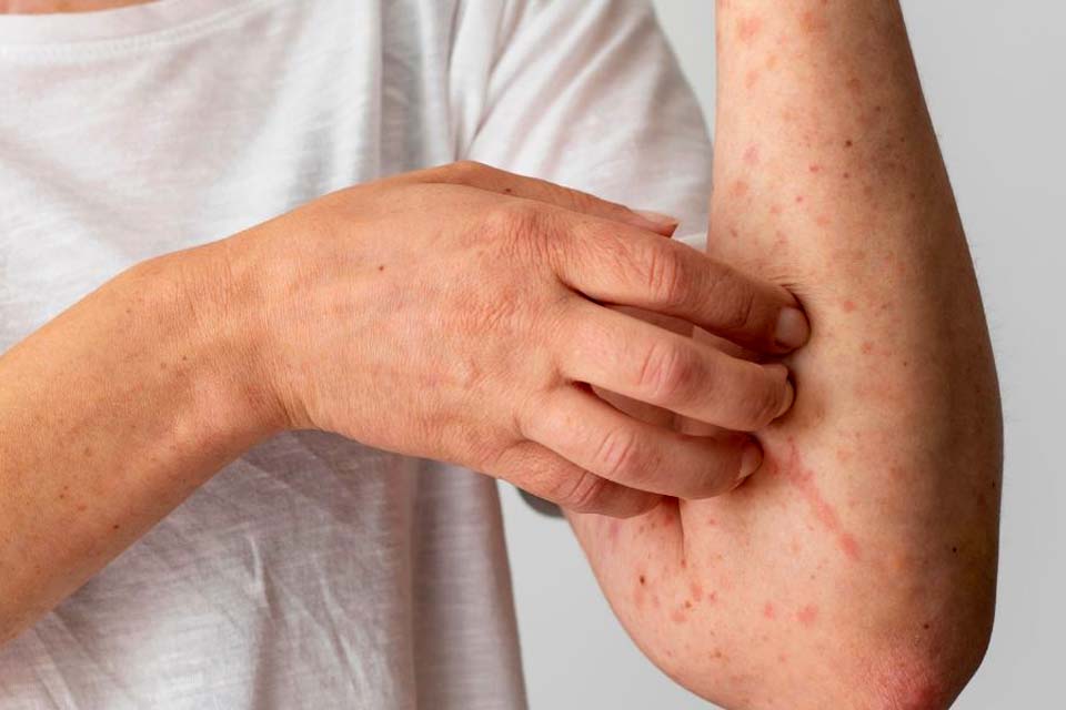 Casos de sarampo aumentam e geram alerta Sociedade de Medicina da Itália 